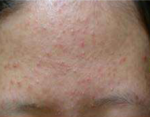 acne-1-before